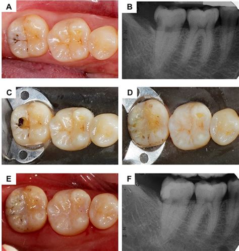 Tunnel Restoration: A Minimally Invasive Dentistry Practice.